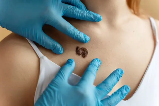 Verão: aumenta o alerta para a prevenção contra o câncer de pele