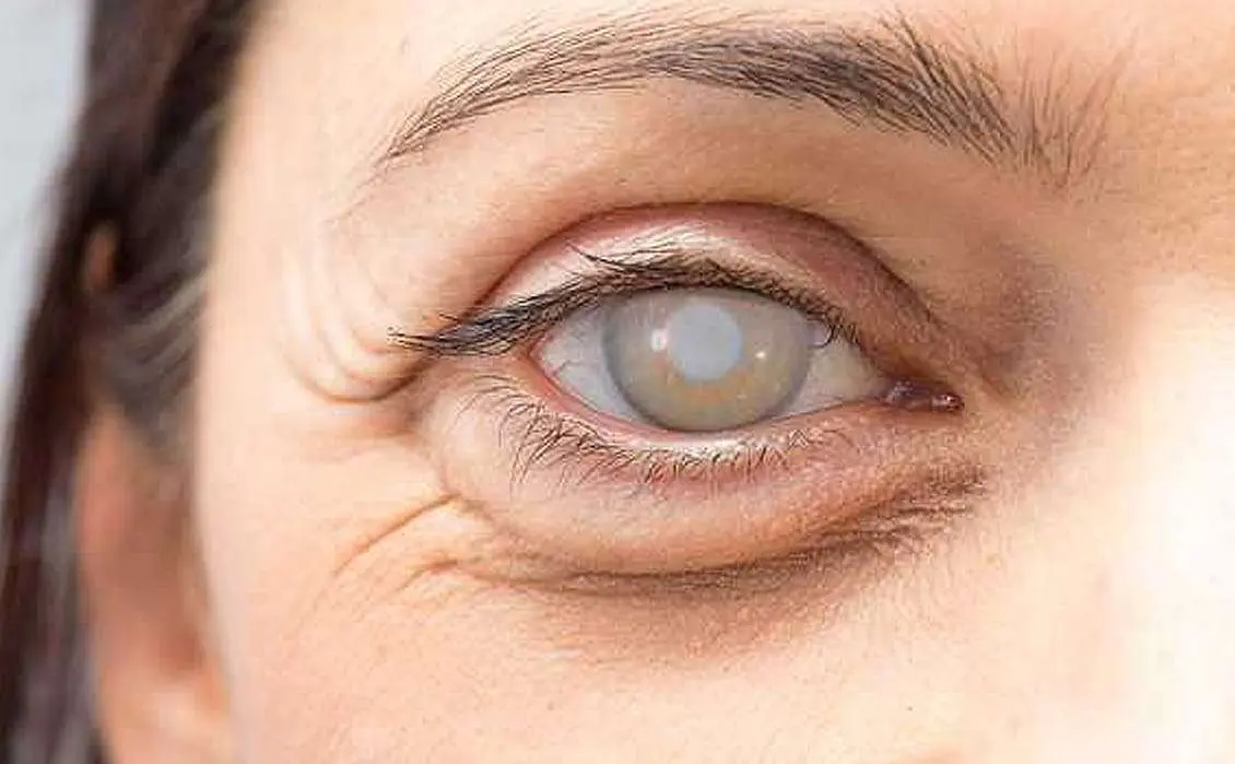 Cirurgia de catarata pode diminuir dependência de óculos