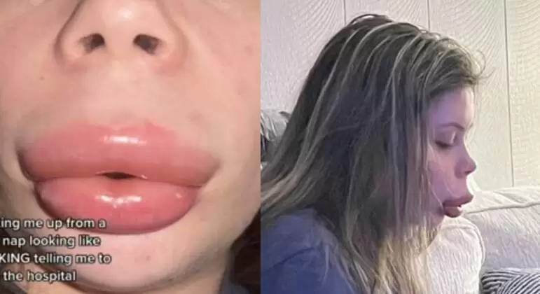 Mulher fica com 'boca de pato' após alergia a preenchimento labial 