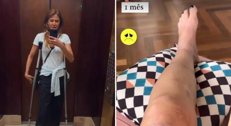 Luciana Gimenez mostra hematomas na perna um mês após acidente grave de ski