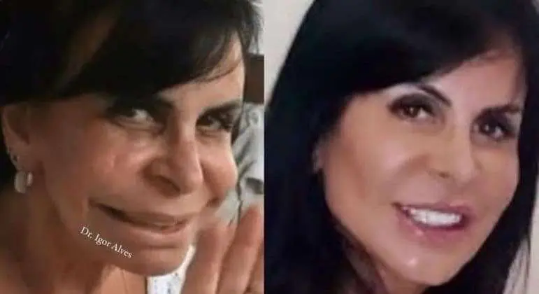 Cirurgia plástica, harmonização: saiba o que é possível deduzir com estética no Imposto de Renda 2023