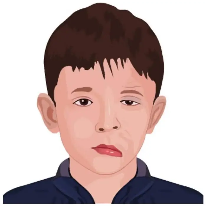 O que é paralisia facial congênita e qual o tratamento?