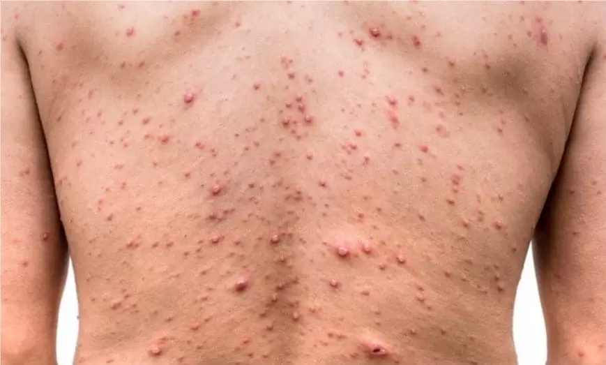 Sífilis não tem vacina e pode passar despercebida; saiba reconhecer os sintomas da infecção