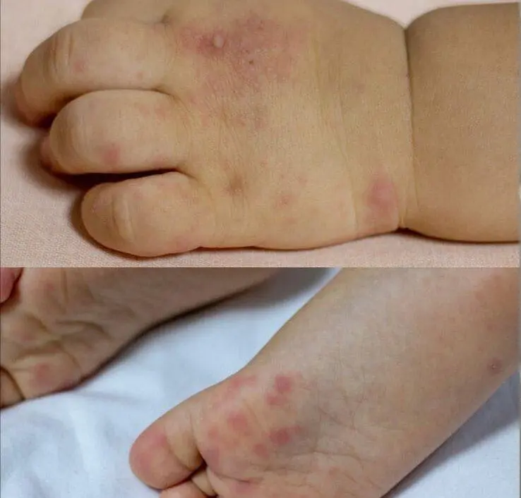 Síndrome Mão-Pé-Boca: saiba os principais conceitos da doença viral