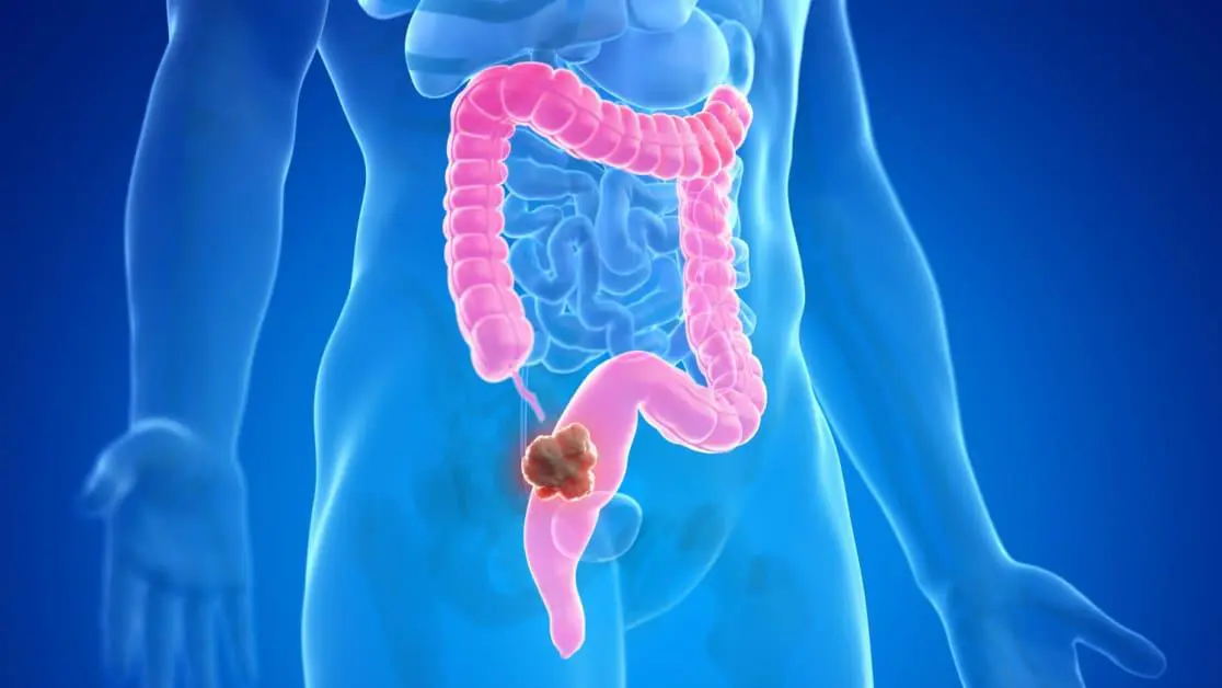 FCecon alerta sobre prevenção ao câncer de intestino