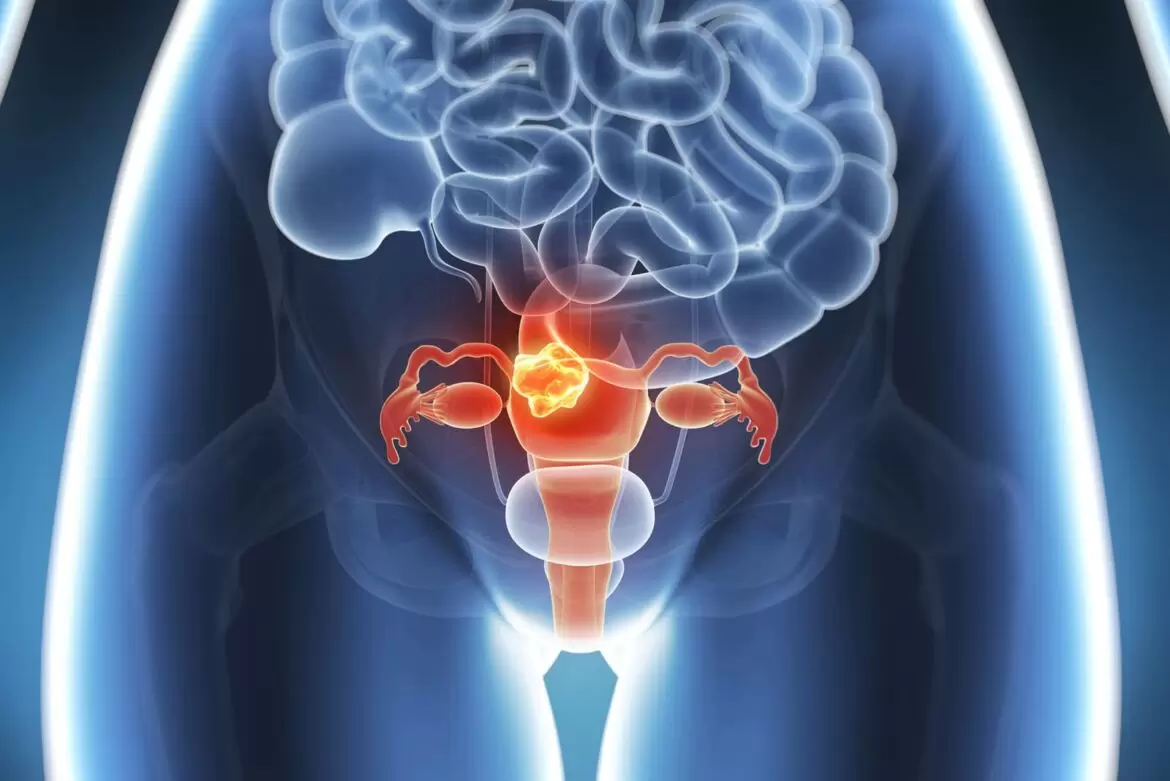 Incontinência urinária acomete cerca de 45% das mulheres