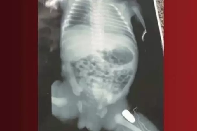 Bebê é baleado na barriga da mãe e sobrevive após cirurgia de emergência