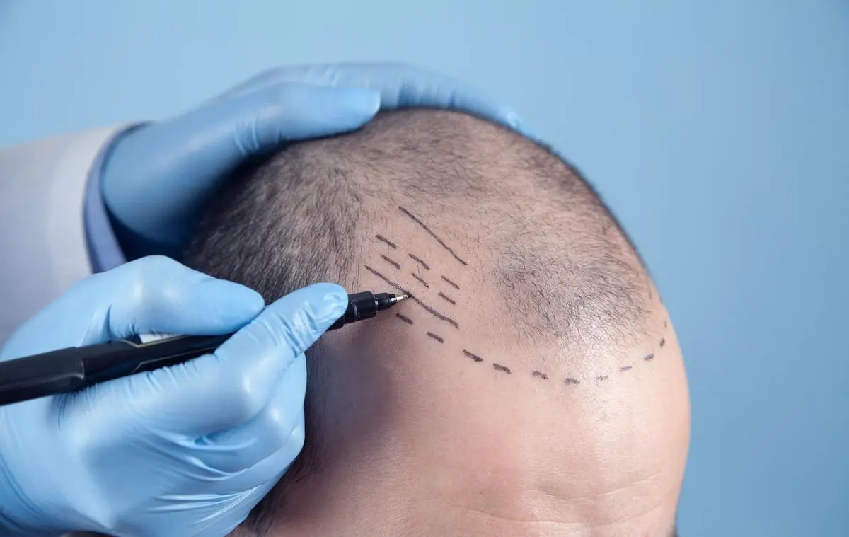 Tecnologia visa mais naturalidade em transplante capilares