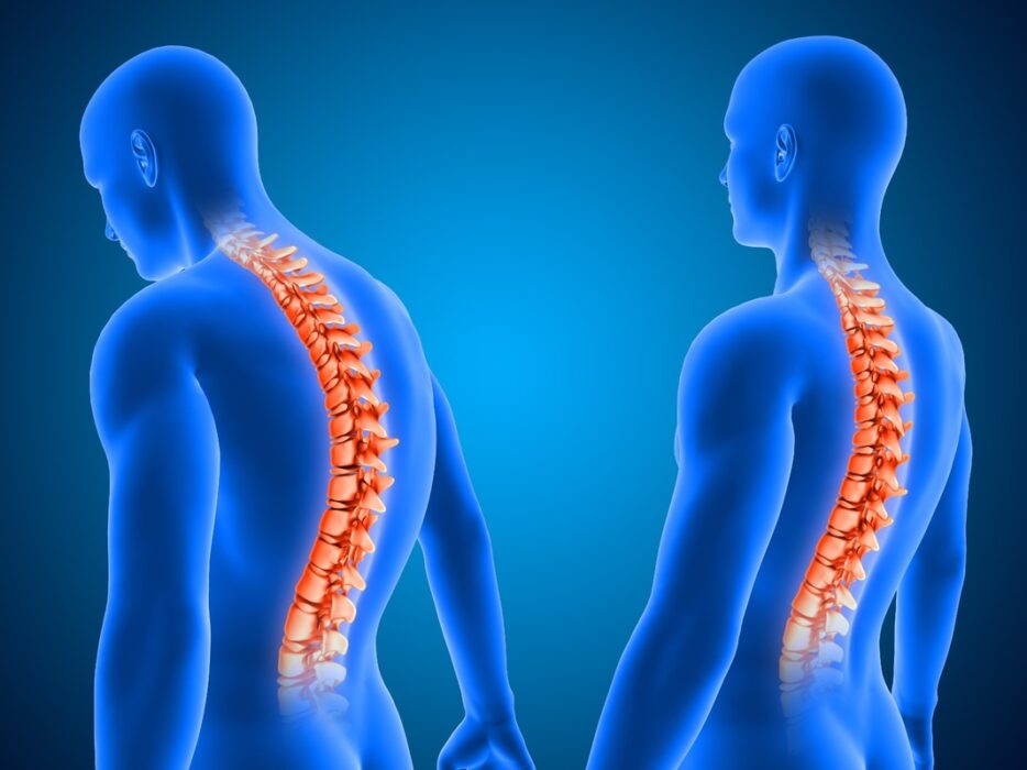 Cirurgia de escoliose é a 1ª com neuronavegação em Uberlândia