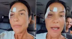 ivete machucada