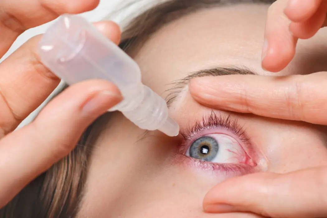 Tratamento da rosácea ocular avança com uso de tecnologia