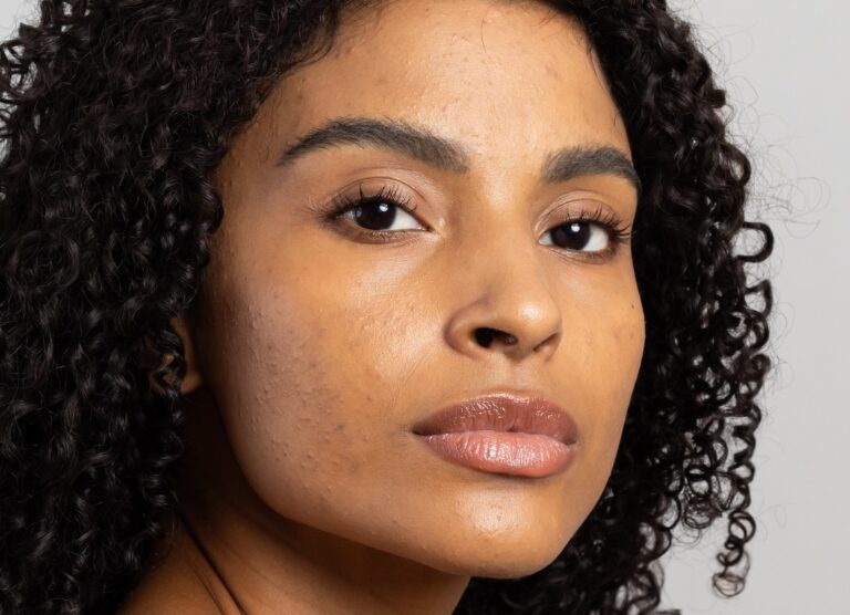 Mês de Conscientização da Acne incentiva cuidados especiais