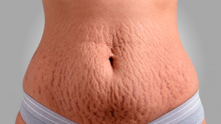 Cirurgia plástica e estética se aliam contra as estrias